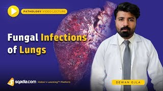 Fungal Infections of Lungs  Actinomycosis Histoplasmosis Coccidioidomycosis  Introduction [upl. by Belinda]