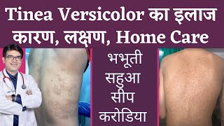 Tinea Versicolar Treatment  भभूतीसीपसहुआकरोडिया का इलाज  Pityriasis Versicolor  In Hindi [upl. by Nnylyram]