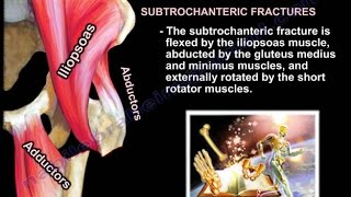 Femur fracture Subtrochanteric fracture  Everything You Need To Know  Dr Nabil Ebraheim [upl. by Ayela]