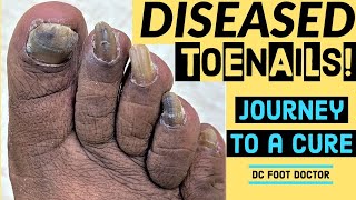 Diseased Toenails Journey To A Cure Trimming Fungal Toenails Onychomycosis [upl. by Elleinnad]