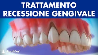 Gengive ritirate  Trattamento recessione gengivale © [upl. by Namyl922]