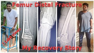 Distal Femur Fracture Recovery Part  1 [upl. by Dolhenty]