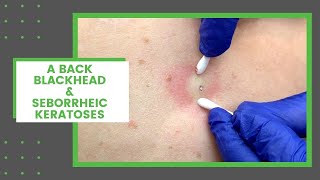 A Back Blackhead amp Seborrheic Keratoses  Dr Derm [upl. by Oremo279]