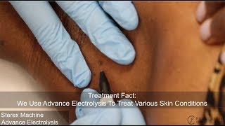 Skin Tag Electrolysis Procedure at Pulse Light Clinic London [upl. by Tlaw265]