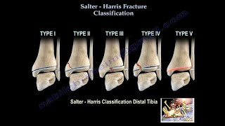 Salter Harris Fracture Classification  Everything You Need To Know  Dr Nabil Ebraheim [upl. by Azarria]