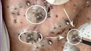 Best Pimple Popping Videos 2021  Blackheads Removal 021 [upl. by Chelsie365]