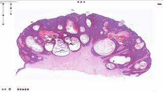 Seborrheic Keratosis Including Variants  Histopathology [upl. by Pasia]