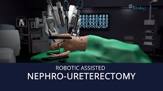 Robot Assisted NephroUreterectomy [upl. by Coppinger]