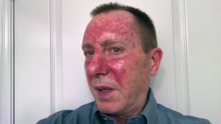 Actinic Keratosis Fluorouracil Treatment 27Day Time Lapse [upl. by Llecrep424]