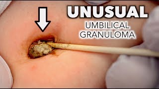 UNUSUAL UMBILICAL GRANULOMA Cauterized With Silver Nitrate  Dr Paul [upl. by Lilahk]