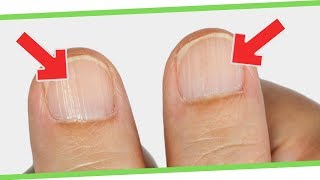 8 ALARMING Things Your Nails Is Warning You About Your HEALTH ⚠️💅 [upl. by Salvay]