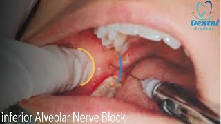 Inferior alveolar nerve block amp Live demo بشرح مفصل [upl. by Pellet]