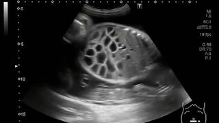 Ultrasound Video showing dilated gut loops of the fetus and anomalies [upl. by Wycoff]