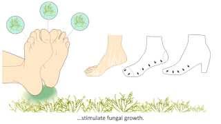 Onychomycosis  What is it and how is it treated [upl. by Hseham]