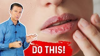 How To Fix Your Chapped Lips – DrBerg On Remedy For Chapped Lips [upl. by Codie]