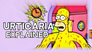 What is Urticaria Hives  EXPLAINED IN 3 MINUTES [upl. by Ayerim815]