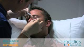 MOLE REMOVAL BY LASER SURGERY [upl. by Crissie]