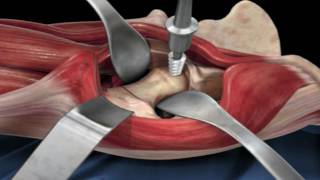 Direct Anterior Approach Hip Replacement [upl. by Sedruol]