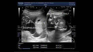 Anencephaly and Encephalocele with a pregnancy of about 16 weeks [upl. by Soneson]